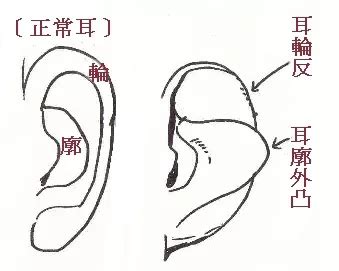 反廓耳|解析面相中的反廓耳